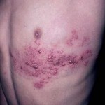 Herpes zoster (shingles)