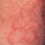 Ringworm Rash 1