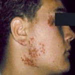 Herpes Simplex 1 (cold sores)