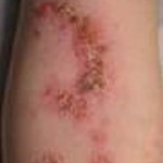 Impetigo on skin